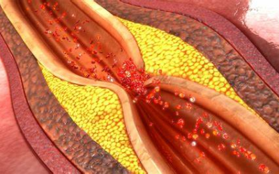 Coronary Artery Disease, Simplified