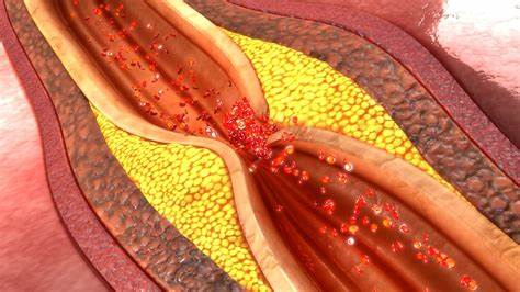 Coronary Artery Disease, Simplified